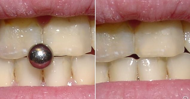 Razones para no ponerse un piercing en la boca – Clinica Dental ...