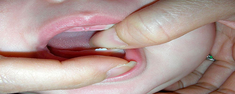 Dientes natales o neonatales. ¿Puede un bebé nacer con dientes?