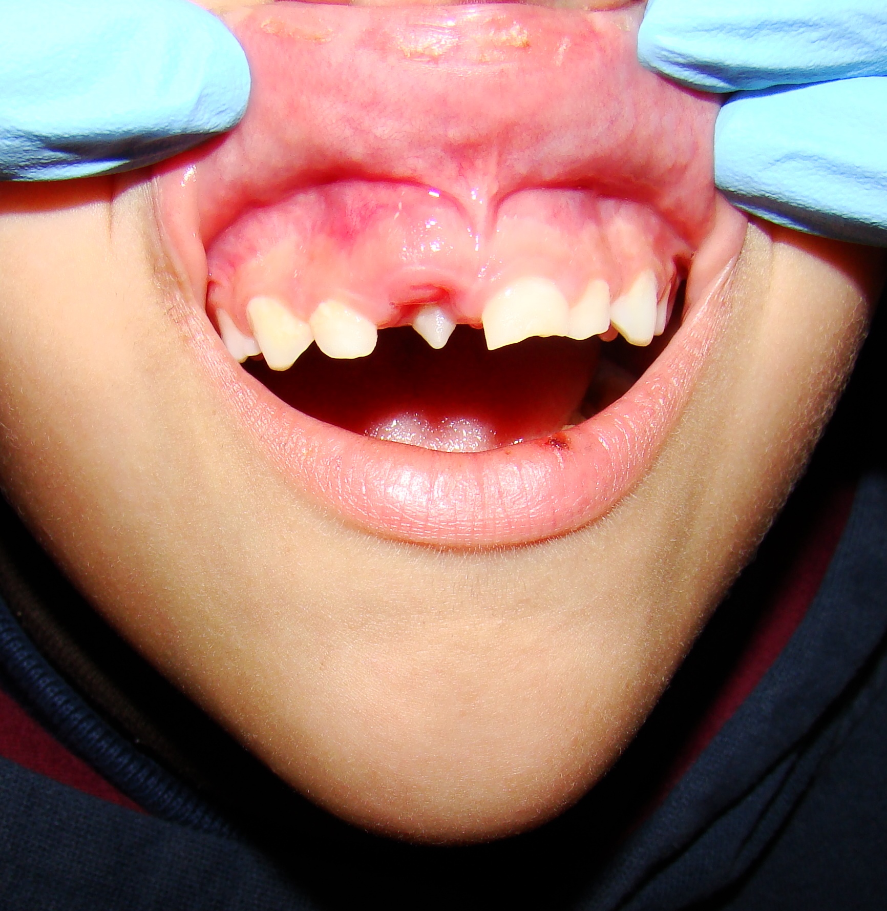 Diente Supernumerario o Hiperdoncia: causas Clinica Dental Erica